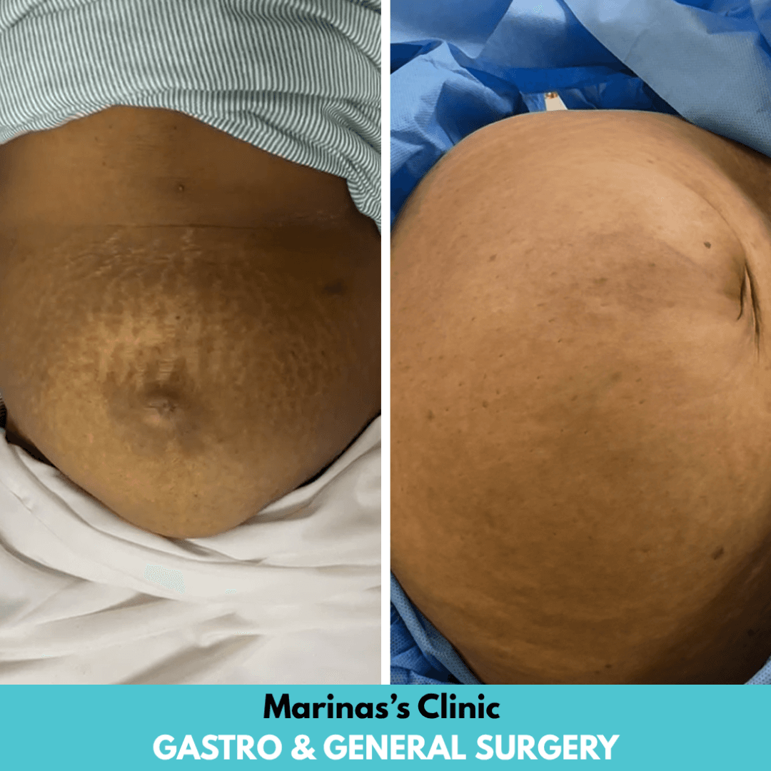 Hernia care before and after image 1