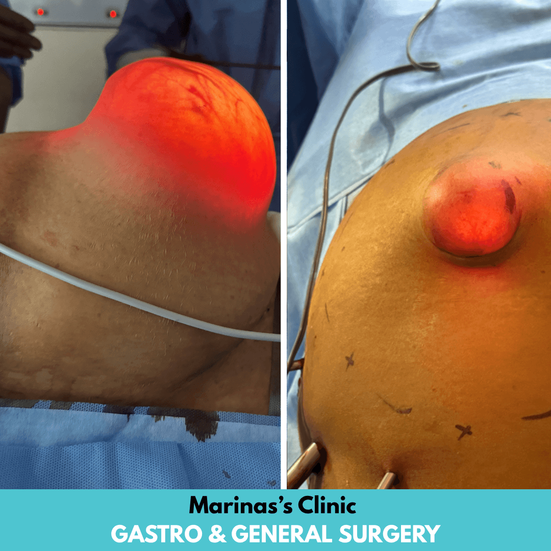 Hernia care before and after image 2
