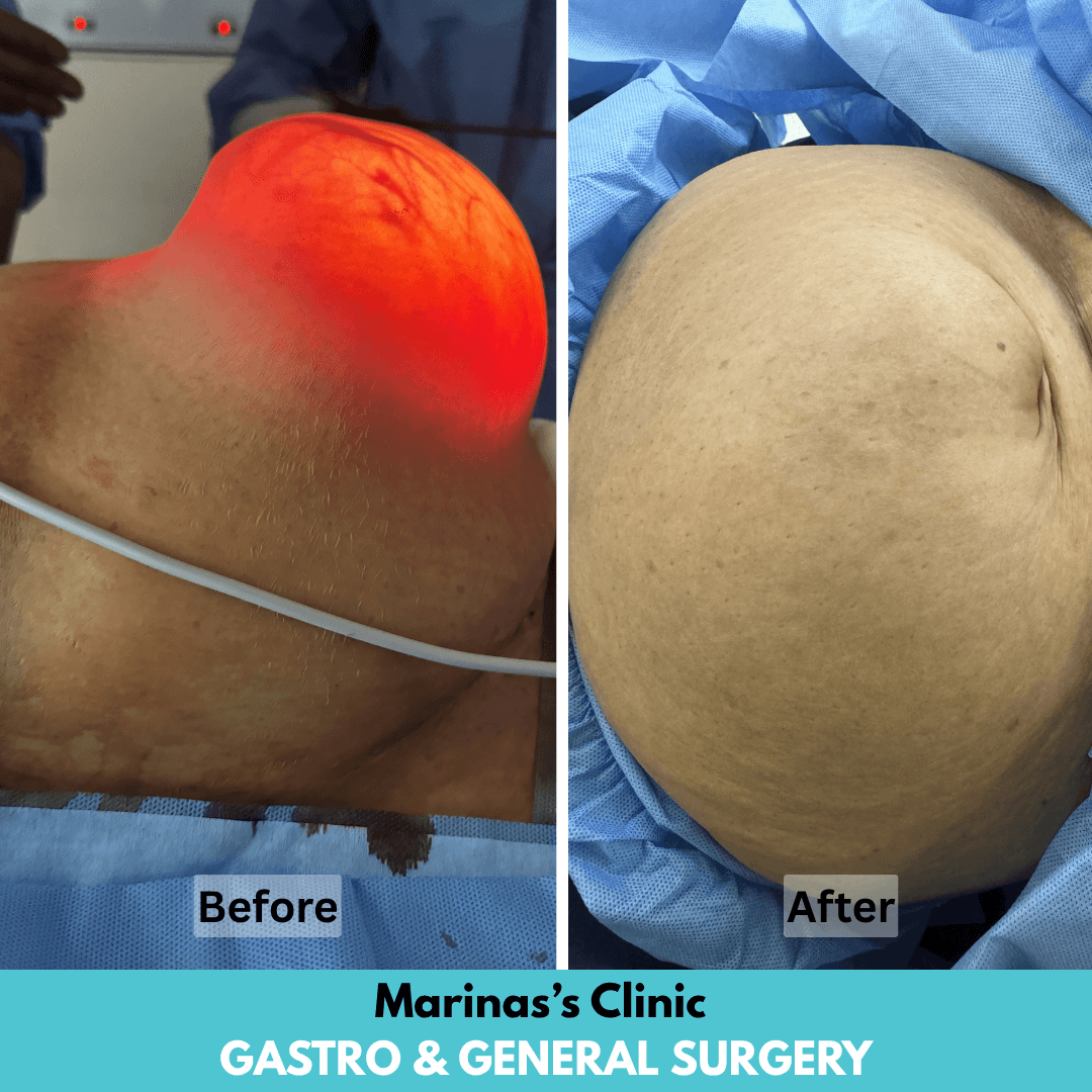 Hernia care before and after image 1