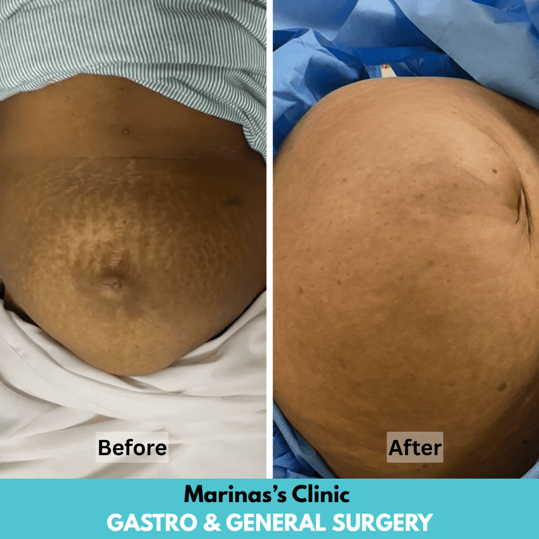 Hernia care before and after image 2