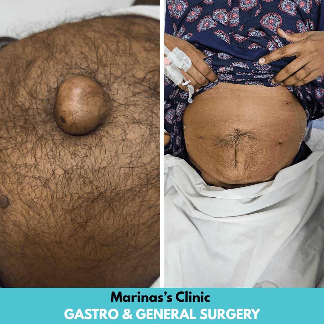 Hernia care before and after image 3